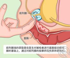 在男科取过前列腺液，才知道自己的深浅1